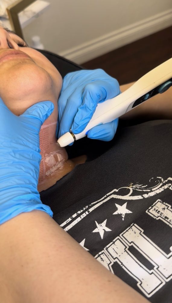 Fibroblast treatment in progress