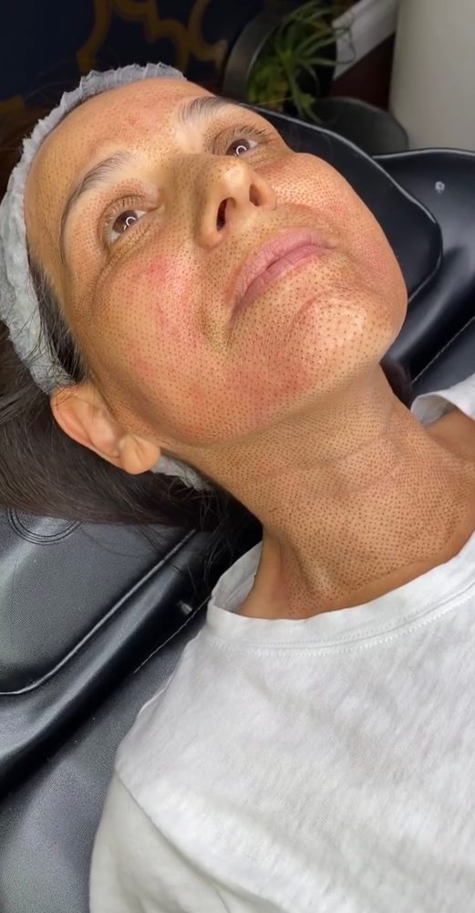 Post-treatment result
