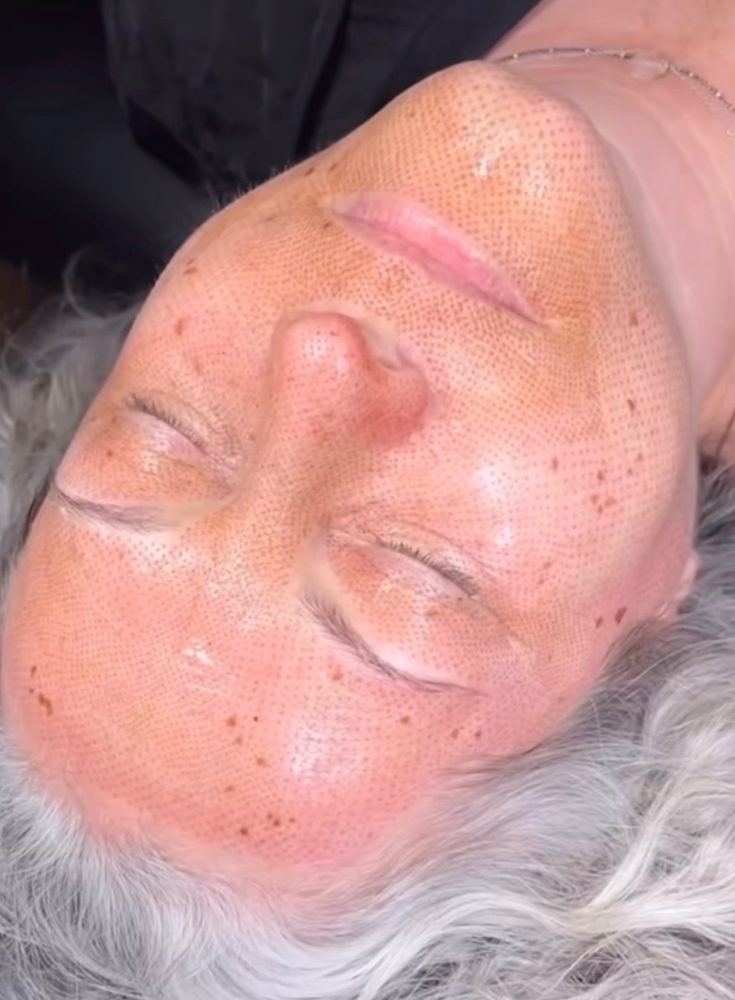 Full face treatment result