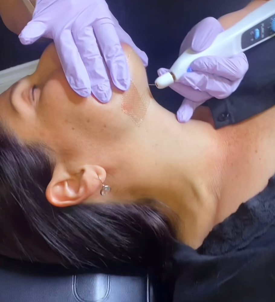 Jaw and neck area treatment