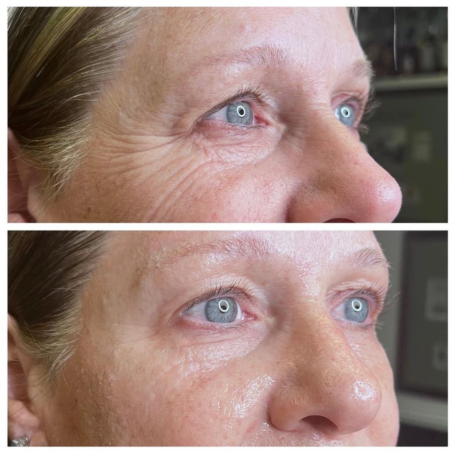 Before and after — eye area skin tightening