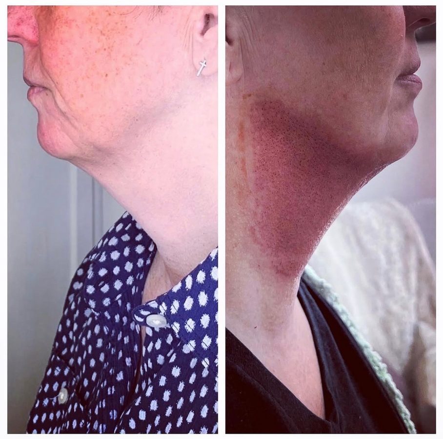 Before and after — neck and jawline tightening