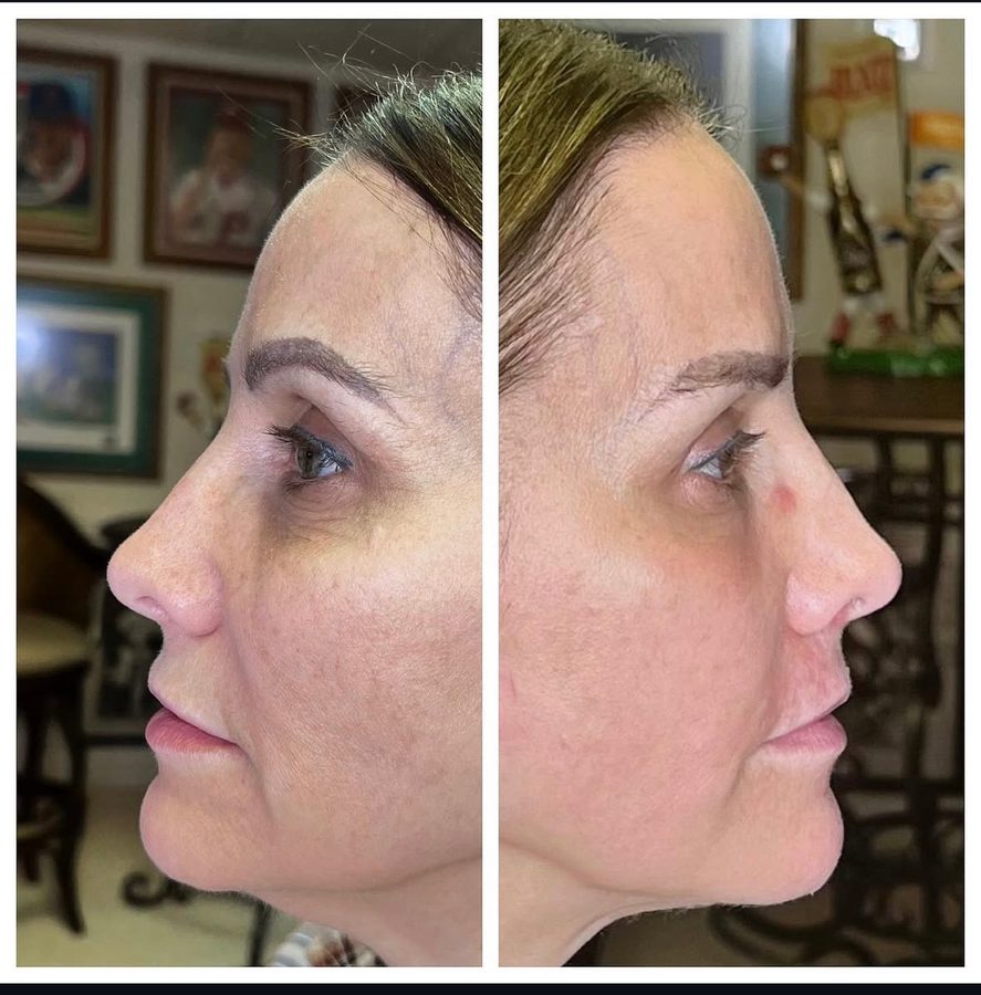 Before and after — facial profile tightening