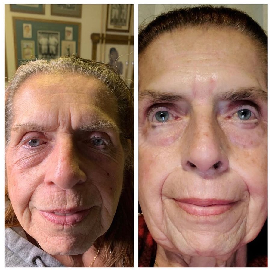 Before and after — full face treatment